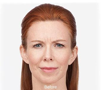 Botox Before & After Patient #1657