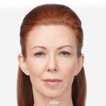 Botox Before & After Patient #1657