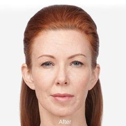 Botox Before & After Patient #1657