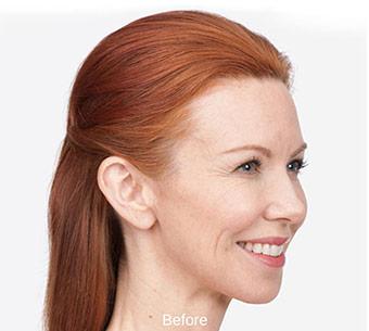 Botox Before & After Patient #1657