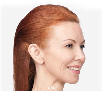 Botox Before & After Patient #1657