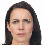 Botox Before & After Patient #1658