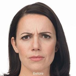 Botox Before & After Patient #1658