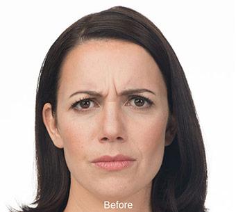 Botox Before & After Patient #1658