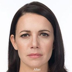 Botox Before & After Patient #1658