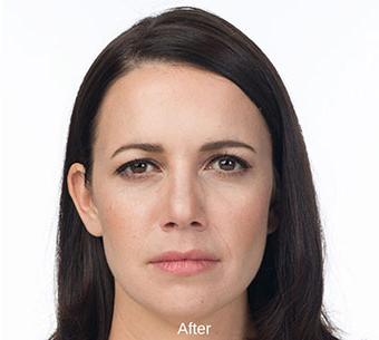 Botox Before & After Patient #1658