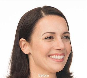 Botox Before & After Patient #1658