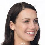 Botox Before & After Patient #1658