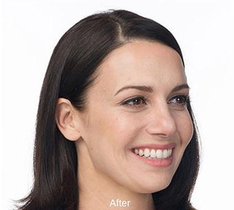 Botox Before & After Patient #1658
