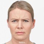 Botox Before & After Patient #1659