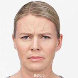 Botox Before & After Patient #1659