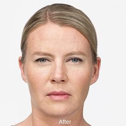 Botox Before & After Patient #1659