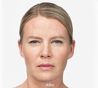 Botox Before & After Patient #1659