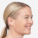 Botox Before & After Patient #1659
