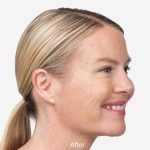 Botox Before & After Patient #1659