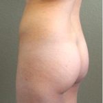 Brazilian Butt Lift Before & After Patient #1192