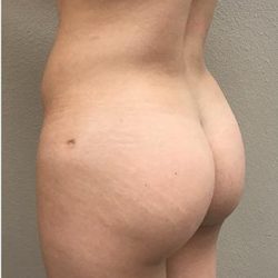 Brazilian Butt Lift Before & After Patient #1192
