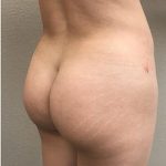 Brazilian Butt Lift Before & After Patient #1192