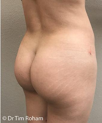 Brazilian Butt Lift Before & After Patient #1192
