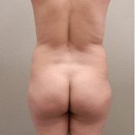 Brazilian Butt Lift Before & After Patient #1193