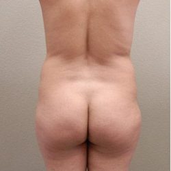 Brazilian Butt Lift Before & After Patient #1193