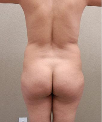 Brazilian Butt Lift Before & After Patient #1193