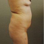 Brazilian Butt Lift Before & After Patient #1194