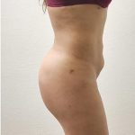 Brazilian Butt Lift Before & After Patient #1194