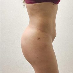 Brazilian Butt Lift Before & After Patient #1194