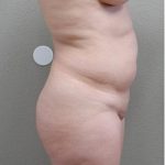 Brazilian Butt Lift Before & After Patient #1196