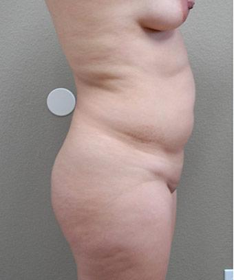 Brazilian Butt Lift Before & After Patient #1196