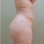 Brazilian Butt Lift Before & After Patient #1196