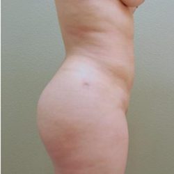 Brazilian Butt Lift Before & After Patient #1196