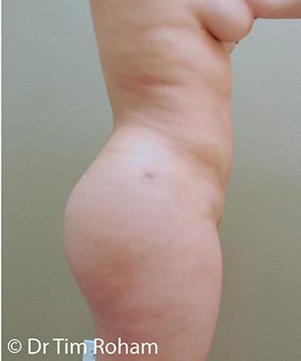 Brazilian Butt Lift Before & After Patient #1196
