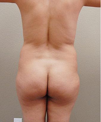 Brazilian Butt Lift Before & After Patient #1197