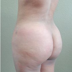 Brazilian Butt Lift Before & After Patient #1198