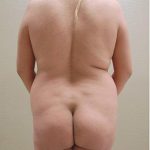 Brazilian Butt Lift Before & After Patient #1199