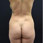 Brazilian Butt Lift Before & After Patient #1183