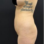 Brazilian Butt Lift Before & After Patient #1183