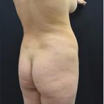 Brazilian Butt Lift Before & After Patient #1183