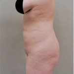 Brazilian Butt Lift Before & After Patient #1184