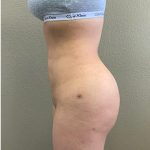 Brazilian Butt Lift Before & After Patient #1184