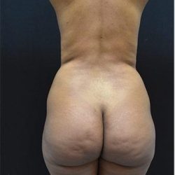 Brazilian Butt Lift Before & After Patient #1185