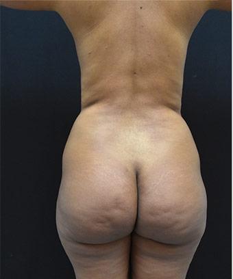 Brazilian Butt Lift Before & After Patient #1185
