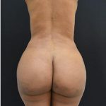 Brazilian Butt Lift Before & After Patient #1185