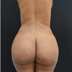 Brazilian Butt Lift Before & After Patient #1185