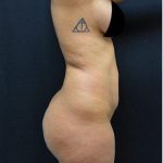 Brazilian Butt Lift Before & After Patient #1185