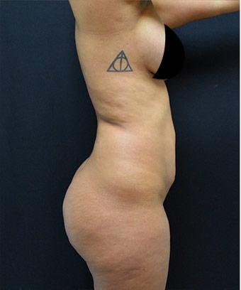 Brazilian Butt Lift Before & After Patient #1185