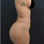 Brazilian Butt Lift Before & After Patient #1185