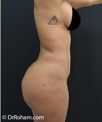 Brazilian Butt Lift Before & After Patient #1185